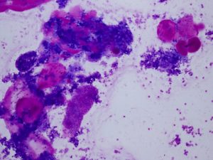 唾液腺腺様嚢胞癌の異染性を示す細胞像（穿刺吸引標本・ギムザ染色標本）
