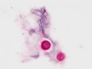 クリプトコッカス（真菌）（ムチカルミン染色標本 x1000）マゼンタ色の菌体の周囲に透明なゾーン（莢膜）が見られる