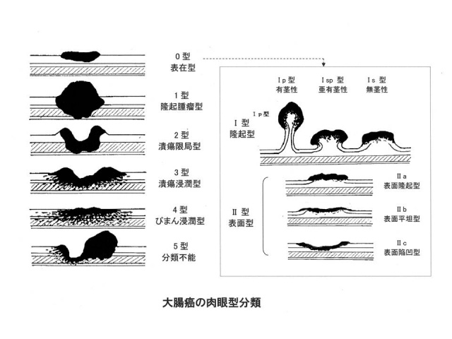 大腸癌の肉眼型分類