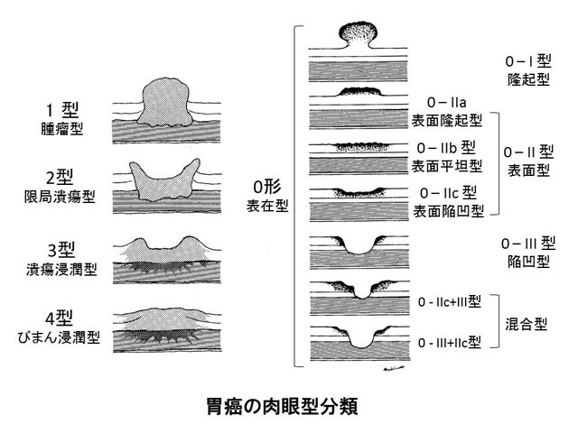 胃癌の肉眼型分類