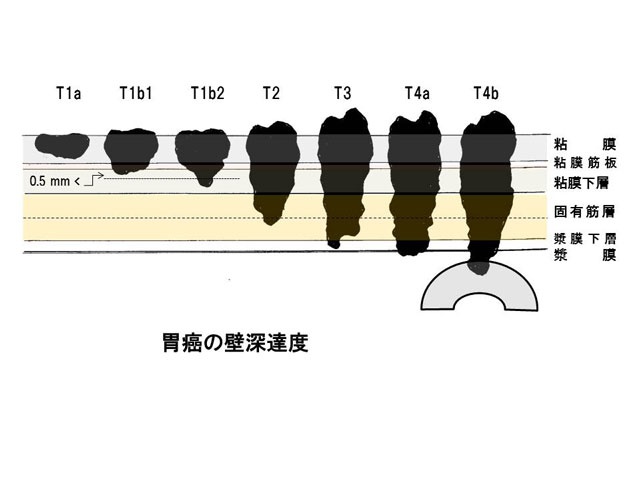 胃癌の壁深達度