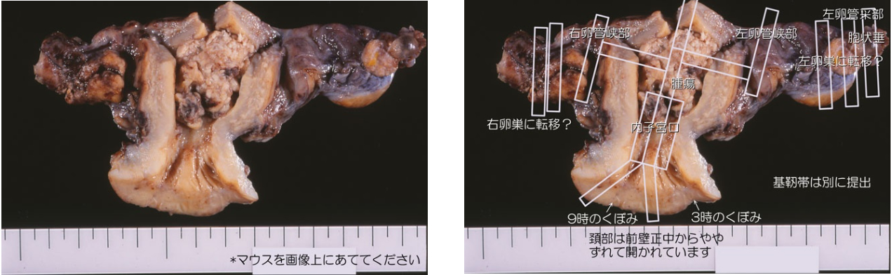 子宮 写真 子宮がん検診の特徴と検診の流れ | 横浜市都筑区の産婦人科 ...