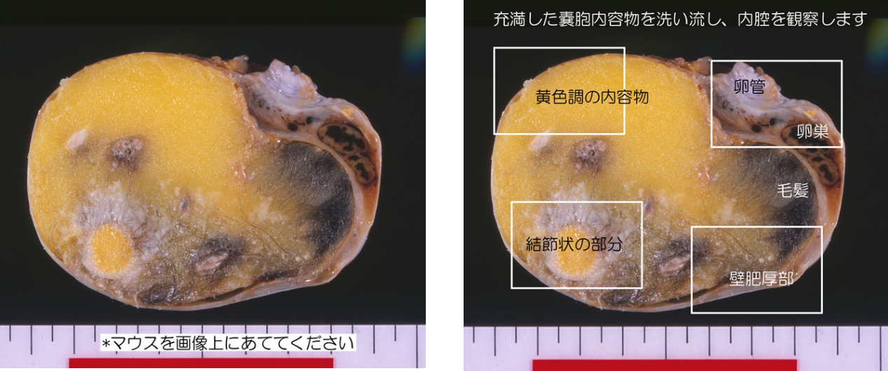 奇形 腫 卵巣