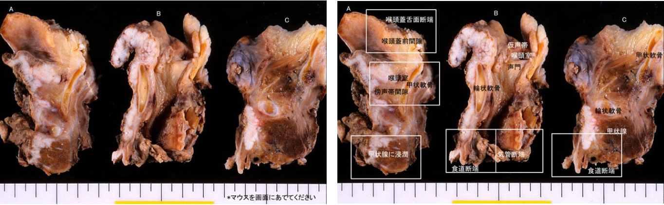 ３ 咽頭 喉頭 頭頚部 病理診断教育支援